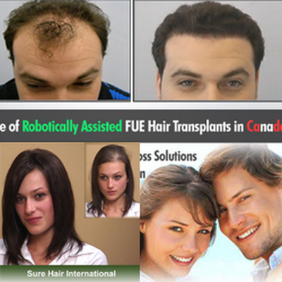 Sure Hair Transplants London